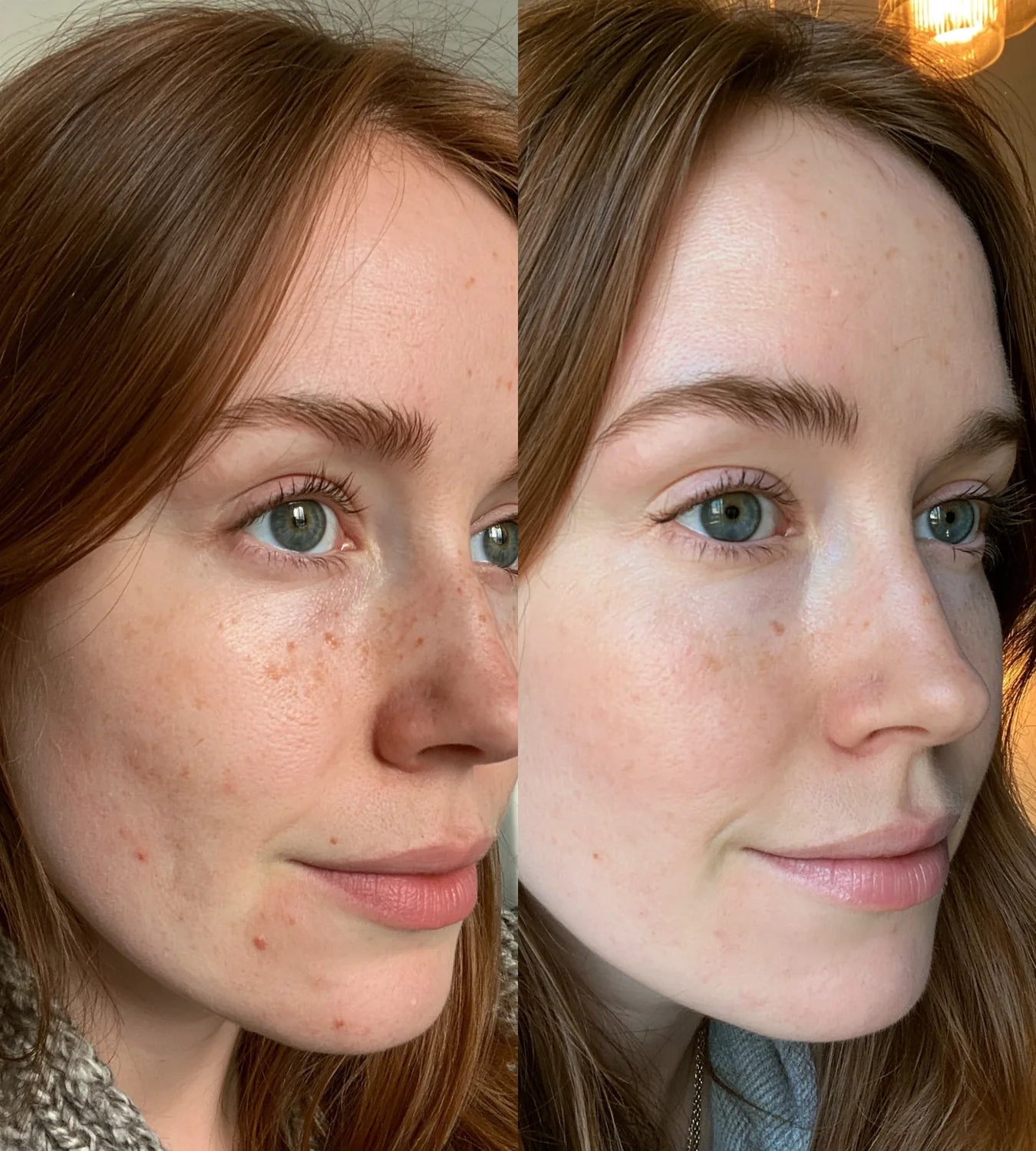 ARCHER before and after result