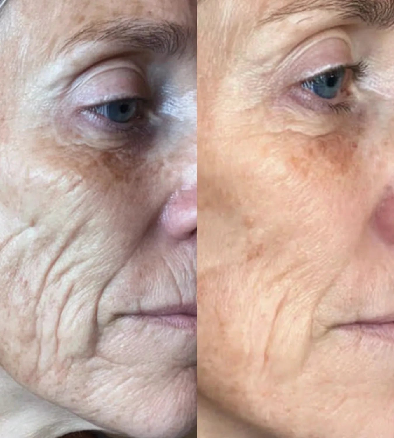 ARCHER before and after result