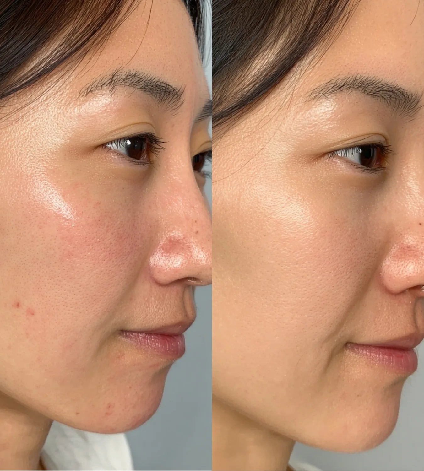 ARCHER before and after result