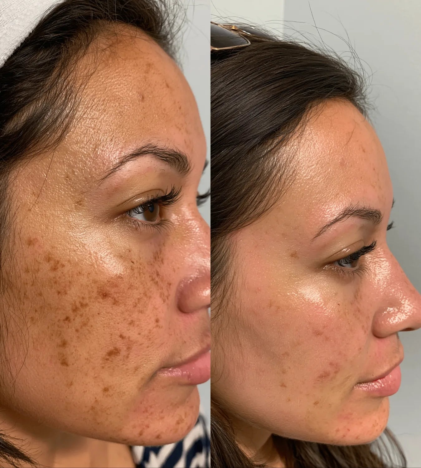 ARCHER before and after result