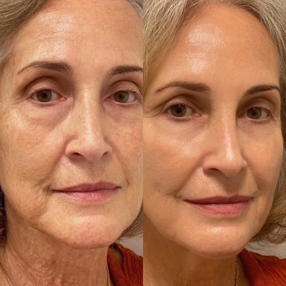After — Day 30