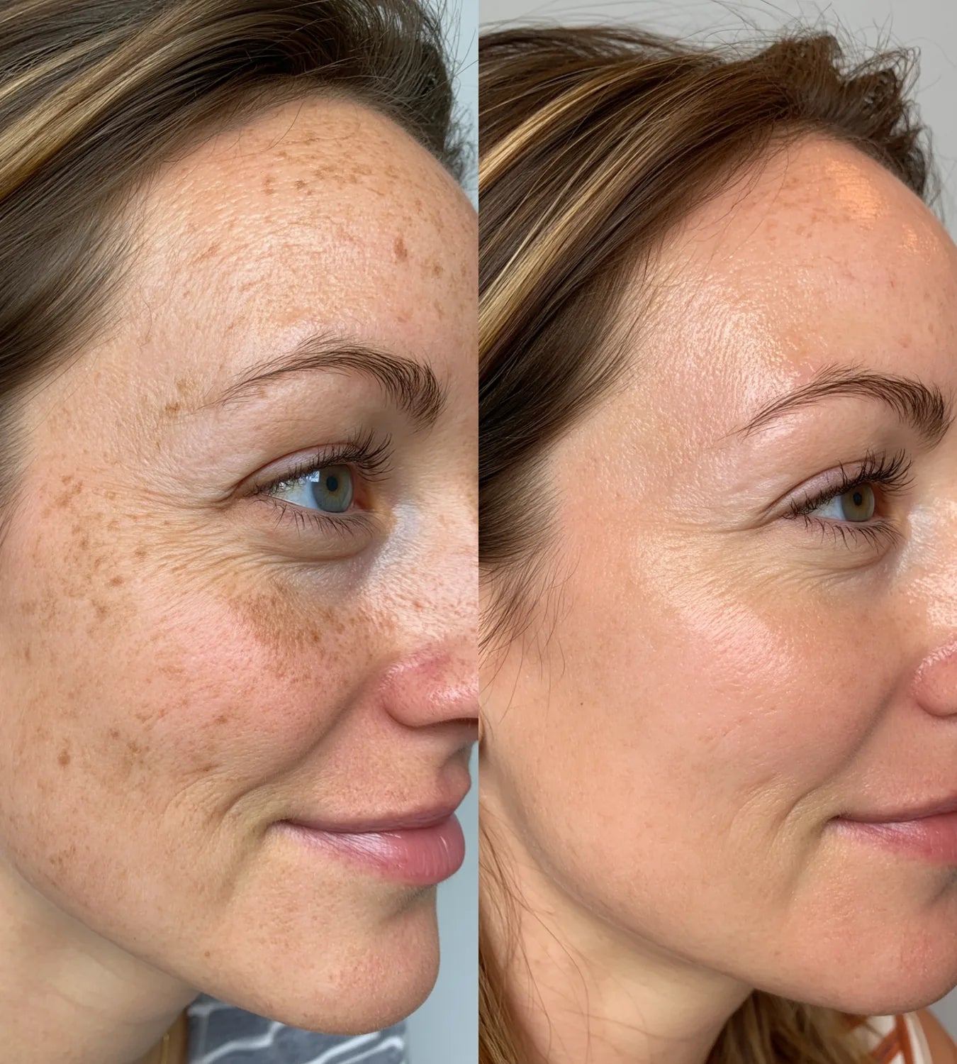 ARCHER before and after result