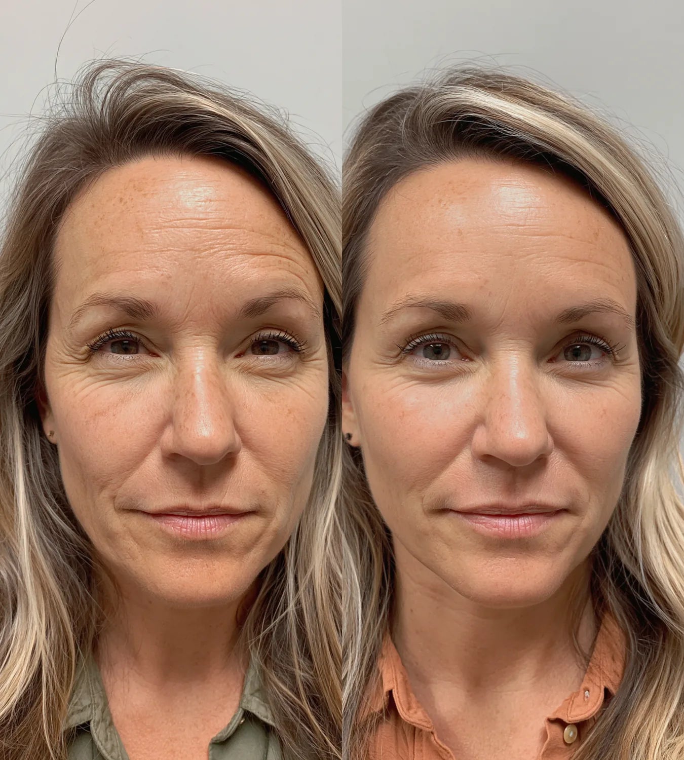 ARCHER before and after result