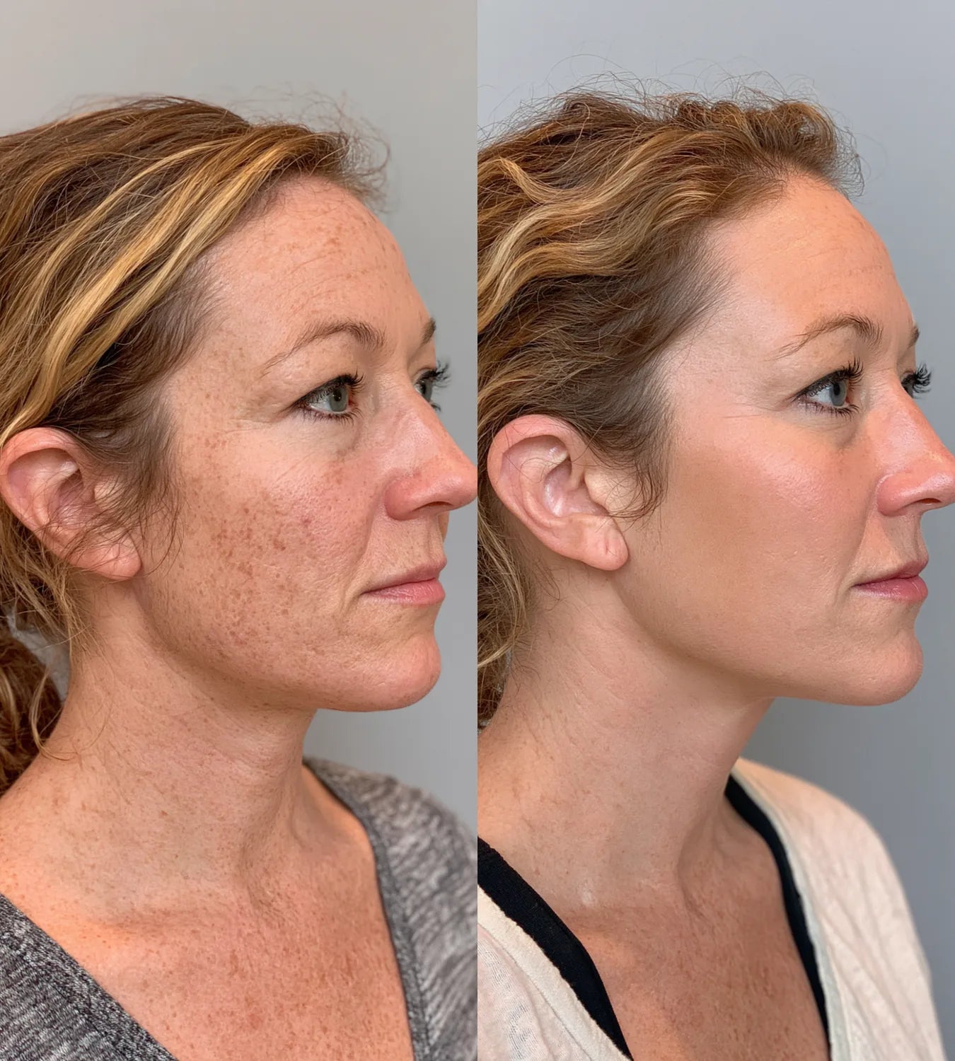ARCHER before and after result