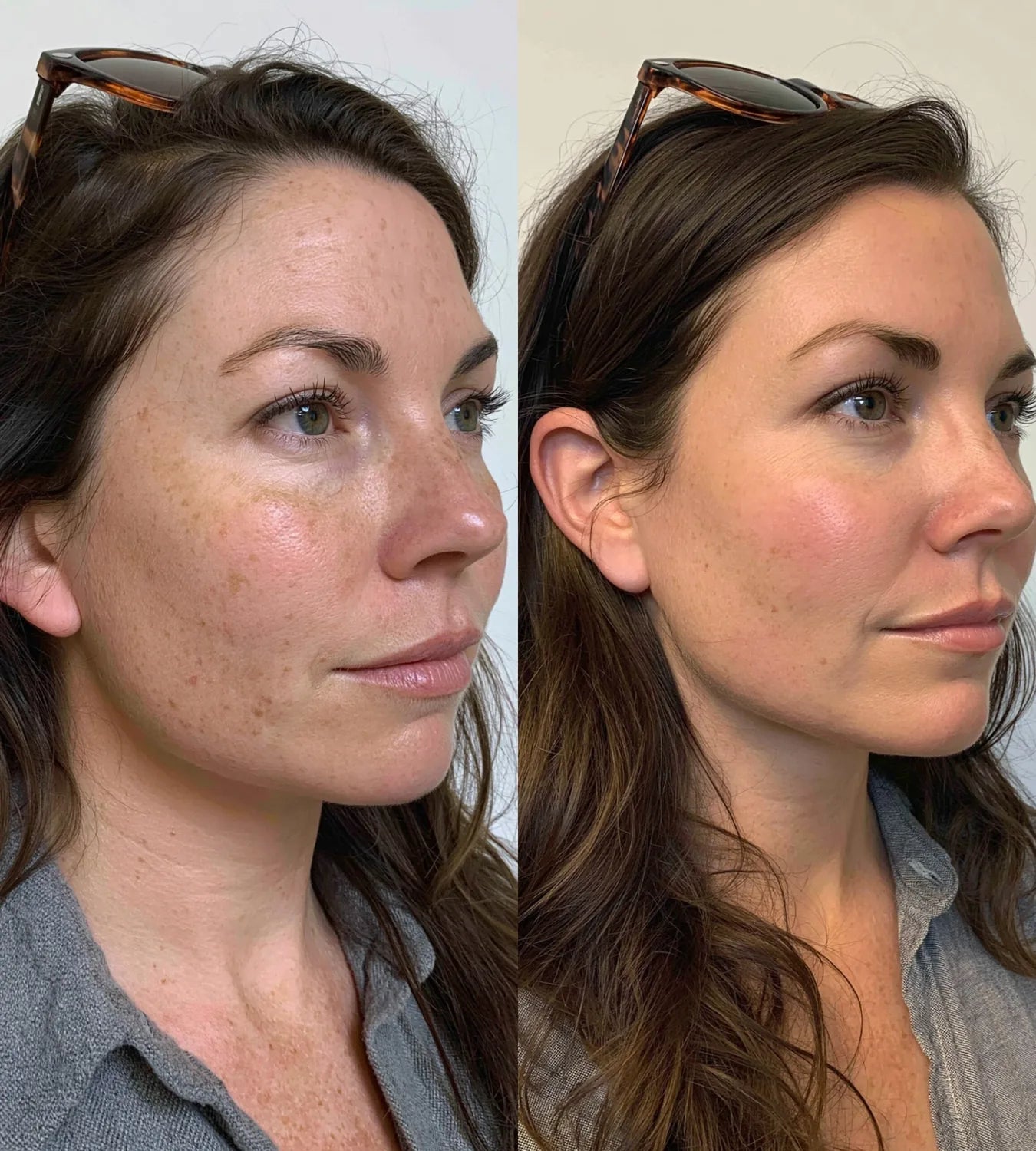 ARCHER before and after result