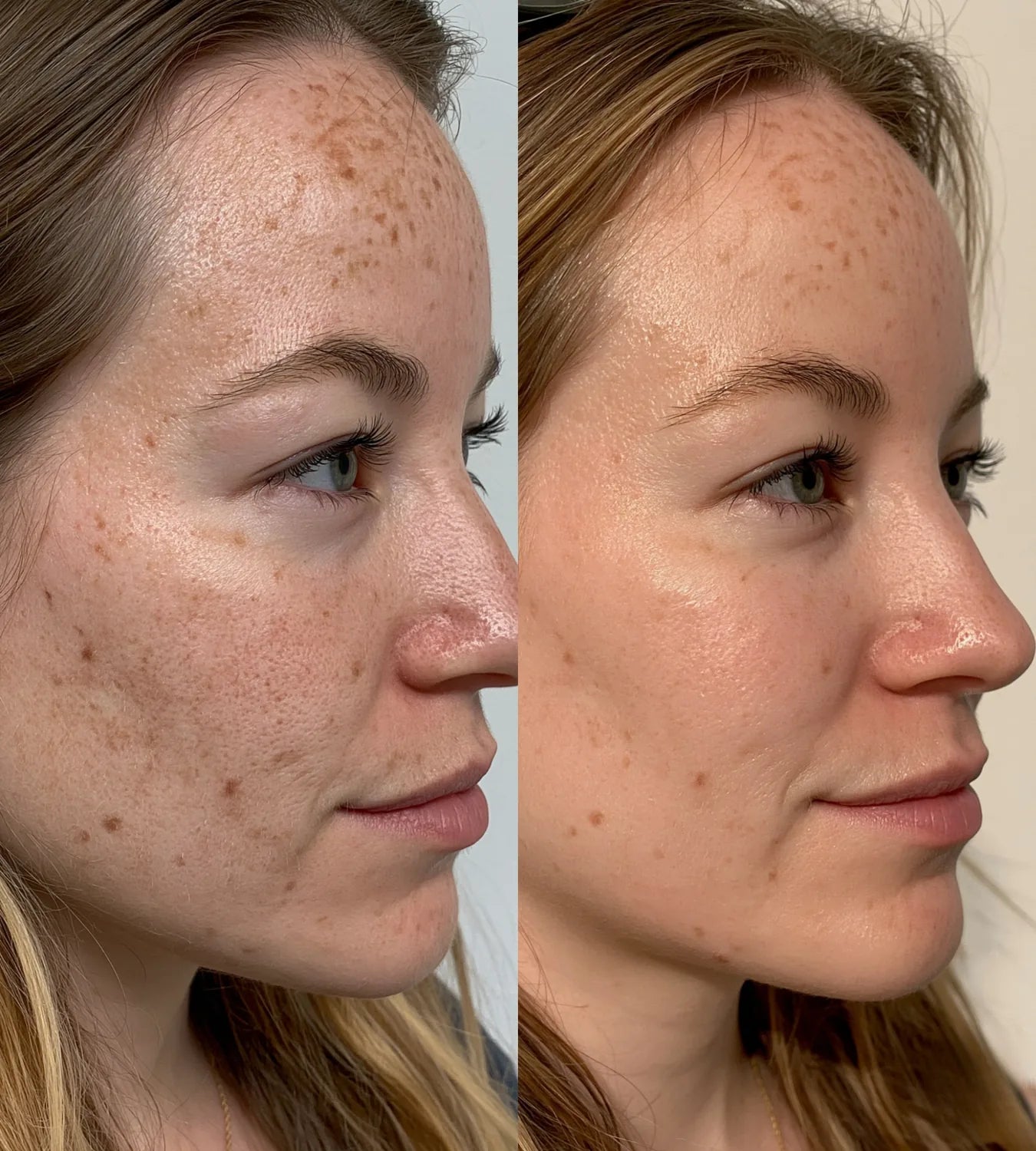 ARCHER before and after result