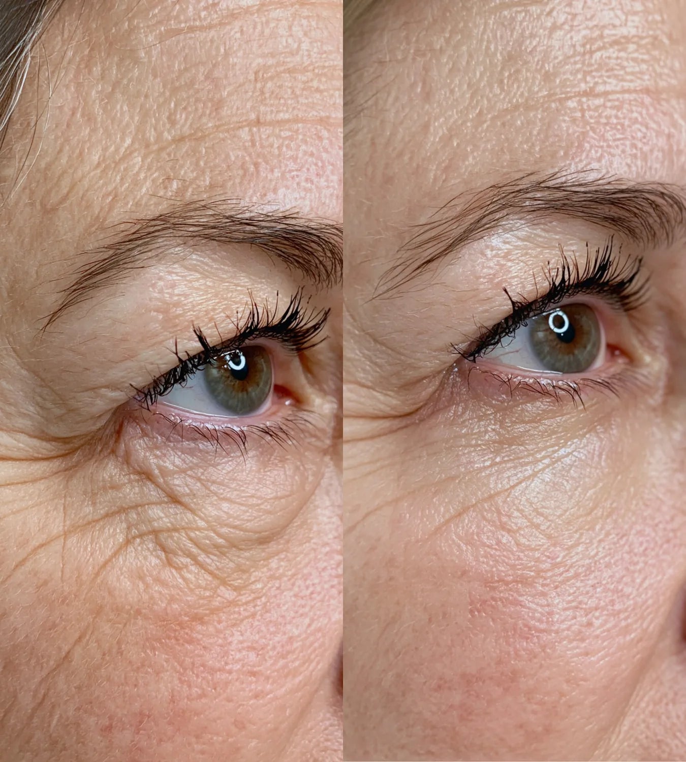 ARCHER before and after result
